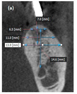 seoul-perfect-dental-cbct-implant-timing-evaluation