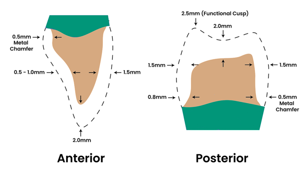 seoul-perfect-dental-crown-indication-anterior-posterior