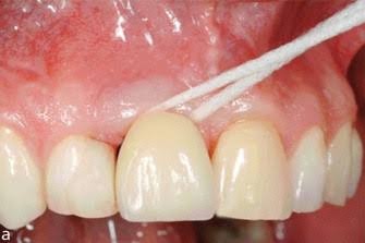 seoul-perfect-dental-oral-hygiene-tools-prevention