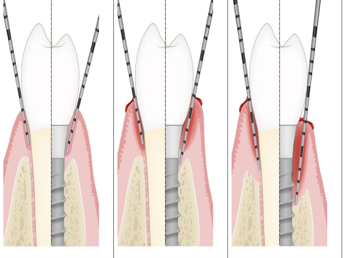 seoul-perfect-dental-implant-anatomy-model