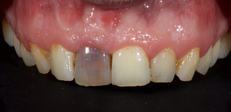 seoul-perfect-dental-anterior-tooth-discoloration