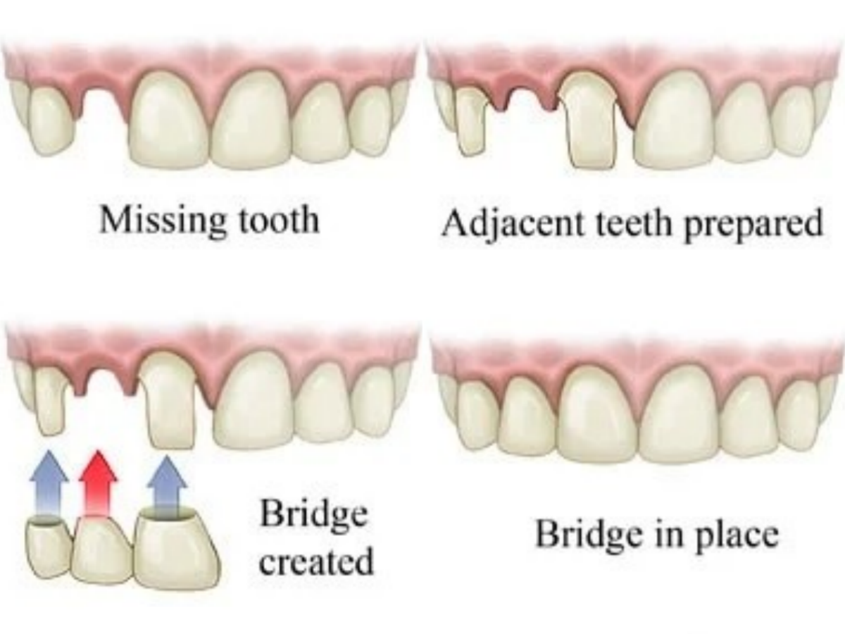 seoul-perfect-dental-bridge-tooth-preparation