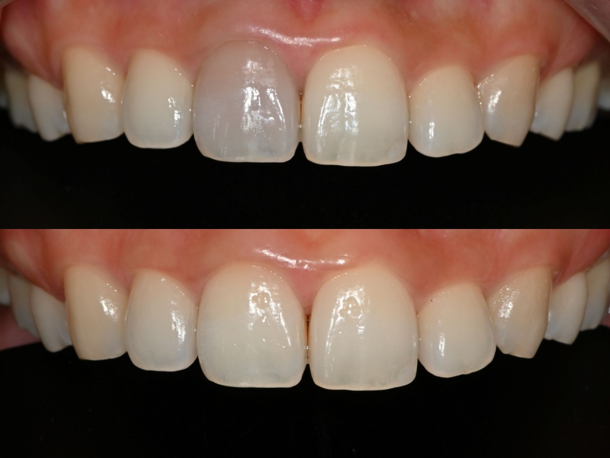 seoul-perfect-dental-internal-bleaching-nonvital