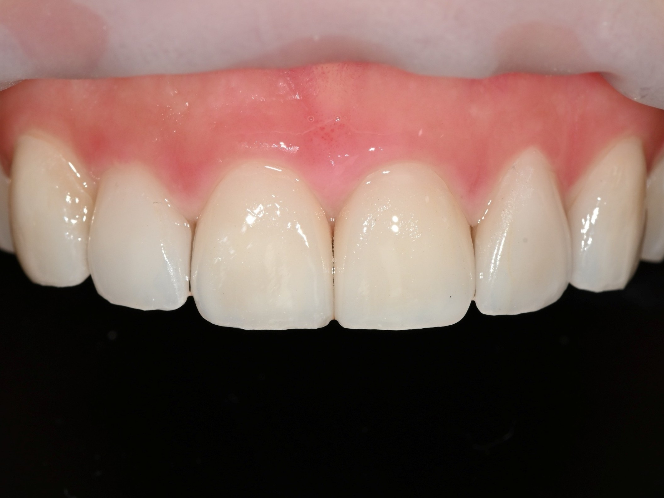 seoul-perfect-dental-laminate-veneer-anterior