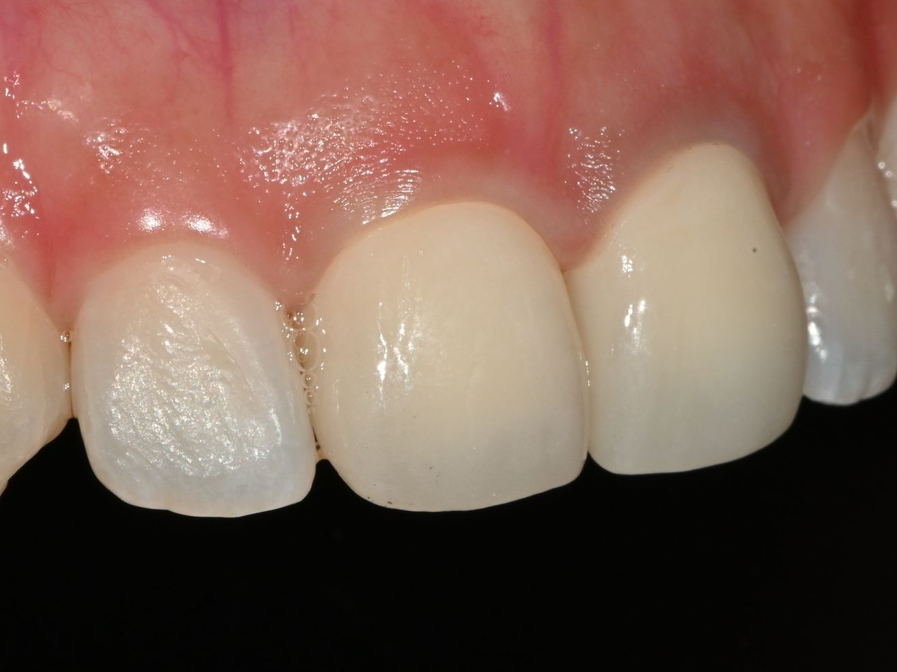 seoul-perfect-dental-zirconia-crown-anterior
