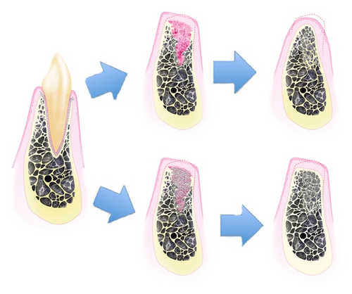 seoul-perfect-dental-implant-bone-preservation