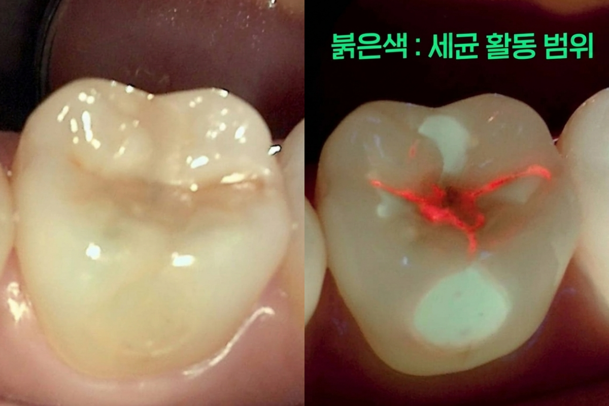 큐레이 촬영 진단 모습 예