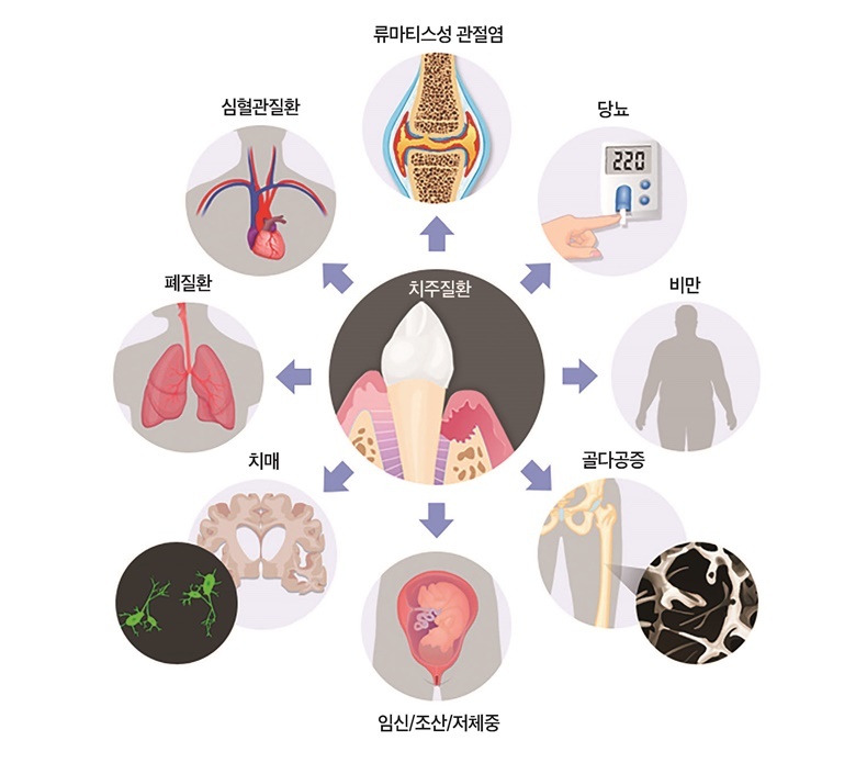 seoul-perfect-dental-흡연, 치주 병력, 당뇨, 교합력
